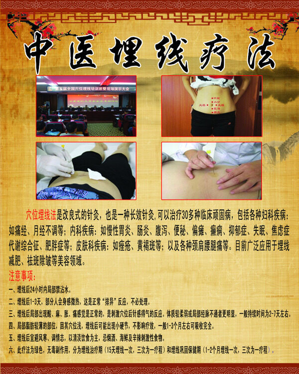 中醫(yī)埋線療法