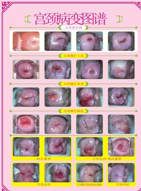 宫颈病变图谱图片